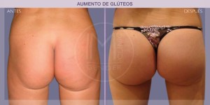 Before and after pictures of buttock augmentation (bottom surgery)